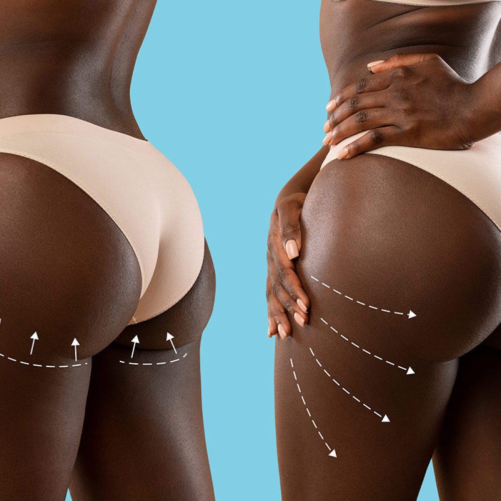 whats-the-difference-between-a-brazilian-butt-lift-and-a-regular-butt-lift